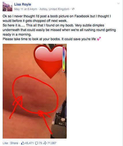 Lisa Royle posted this picture of her breast warning others to look out for subtle breast cancer symptoms before she underwent a mastectomy. Photo: Facebook