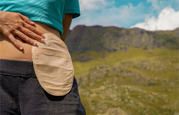 Imagen de la bolsa cuando se hace ostomía