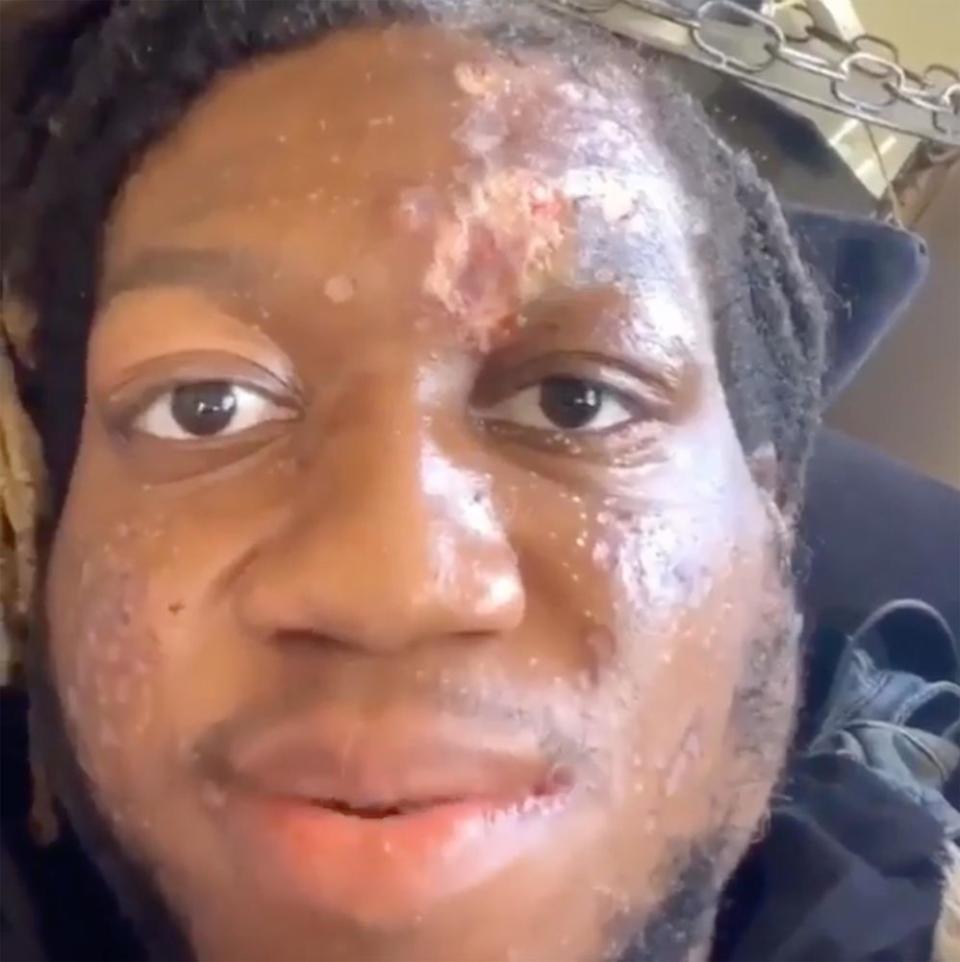 Rapper OG Maco Reveals He Has a 'Skin-Eating Disease'