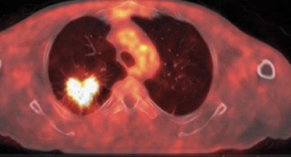 A heart-shaped lesion seen on a man's lung during a CT scan.