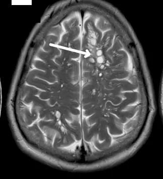 A scan of the man's brain, shown in this image, revealed that he had many clumps of tapeworm larvae growing in different parts of his brain believed to be caused by undercooked bacon.