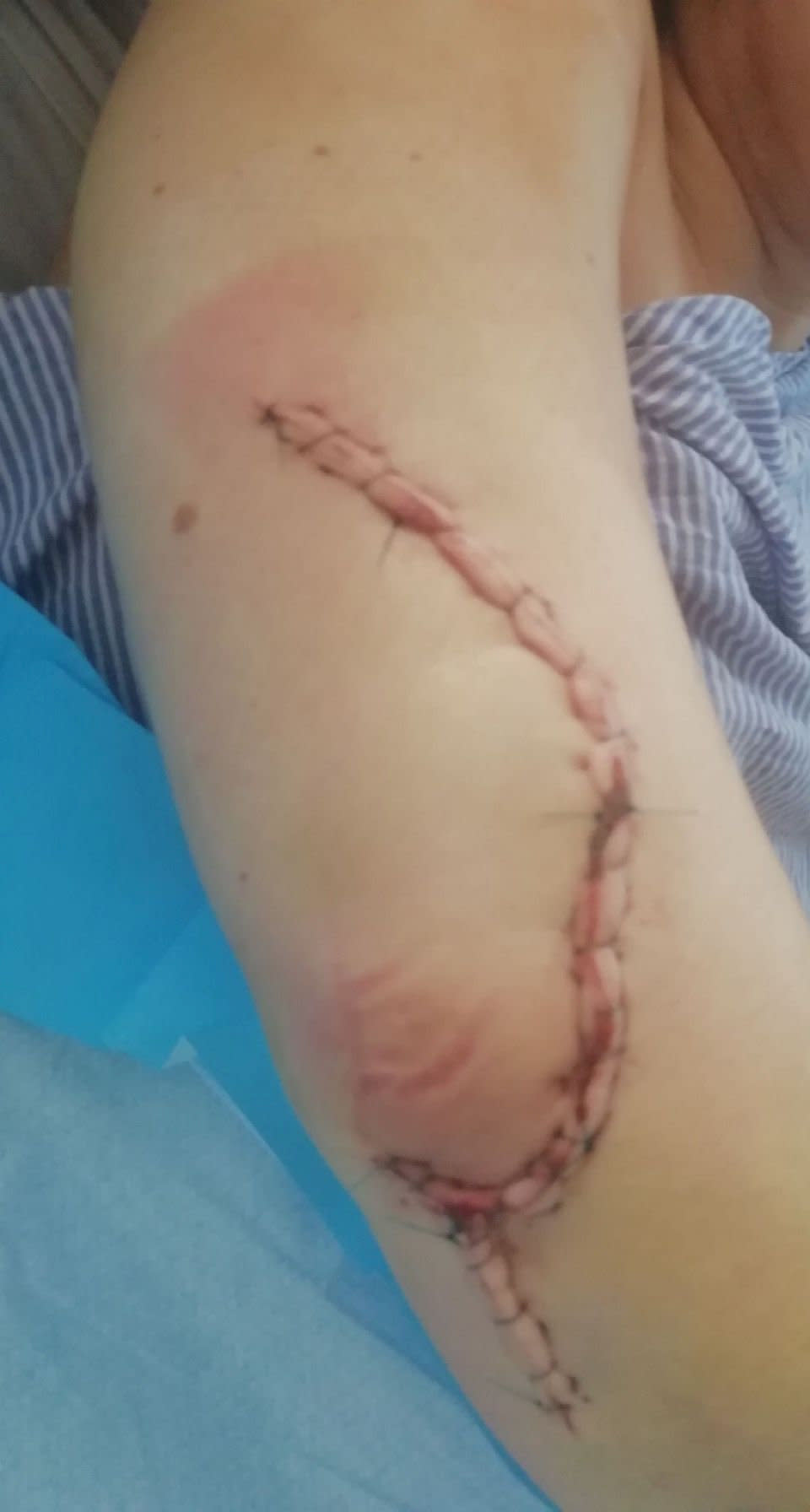 Lucy Wyles was knocked unconscious, her arm was shattered, she had a pelvis fracture, blood clots and facial damage as a result of the collision. (SWNS)