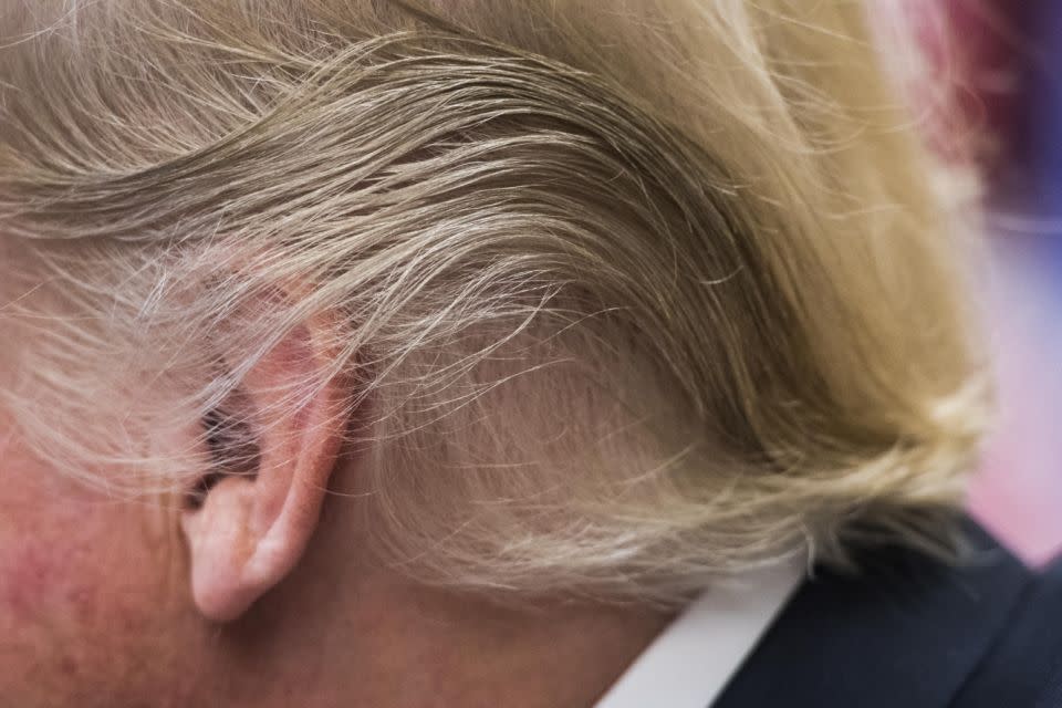 Another theory suggests he had a hair transplant. Photo: Getty