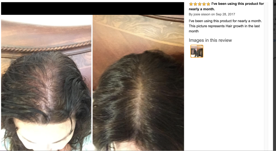 This before-and-after shows one Amazon reviewer's amazing results. (Photo: Amazon)