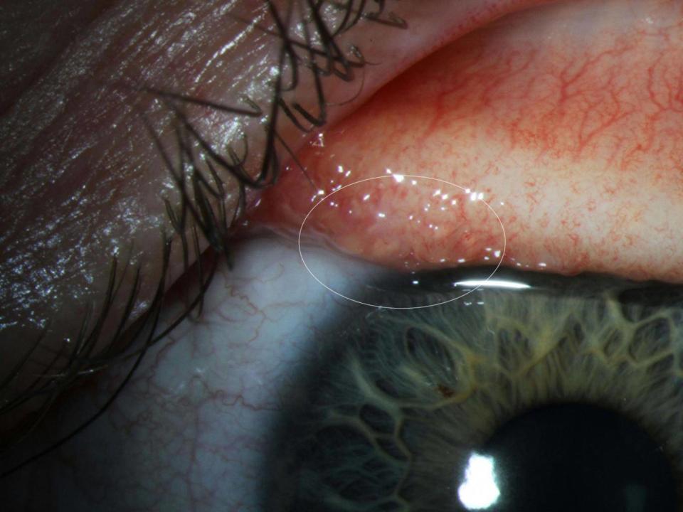 An image released by the CDC shows Ms Beckley's infected eye. The flies feed on the tears that lubricate the eyeball, scientists said (CDC)