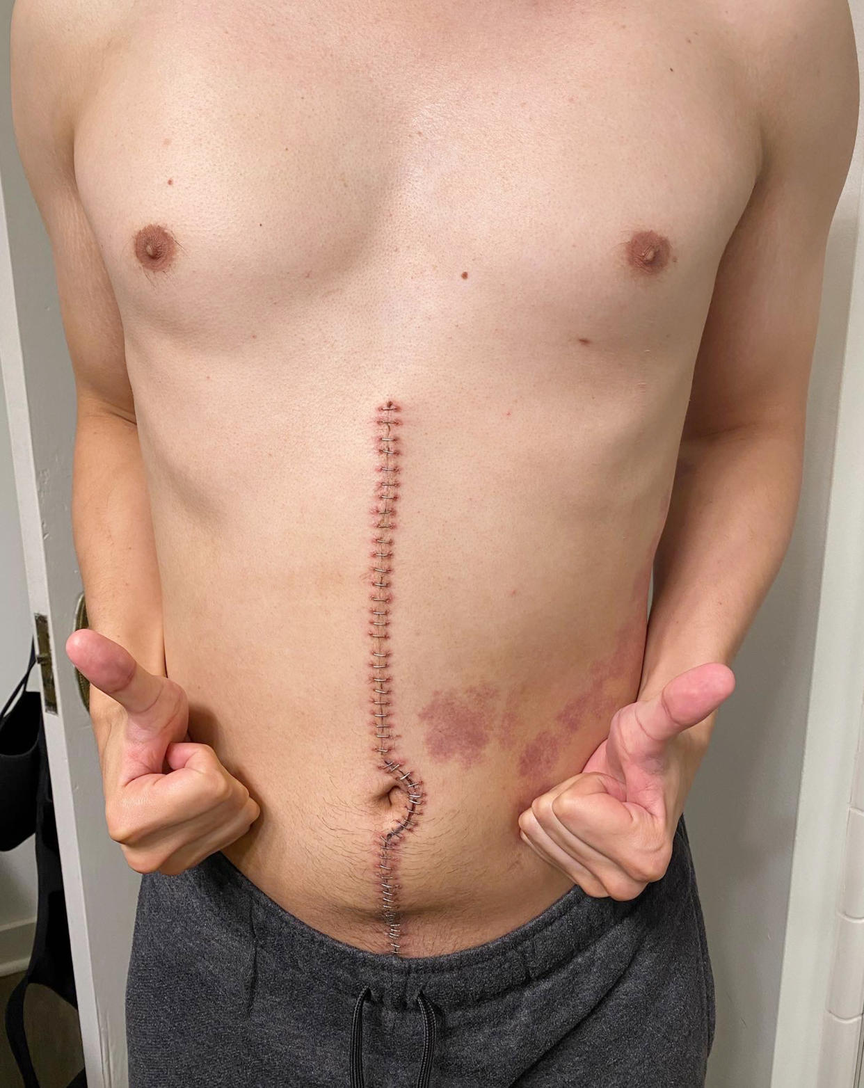 Even after chemotherapy, Sal Gomez's lymph nodes looked enlarged. He underwent an 8-hour-long procedure to have some removed. (Courtesy Sal Gomez)