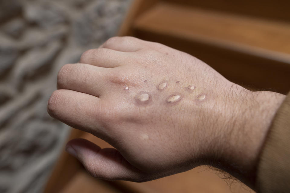 Monkey pox vesicles in a hand