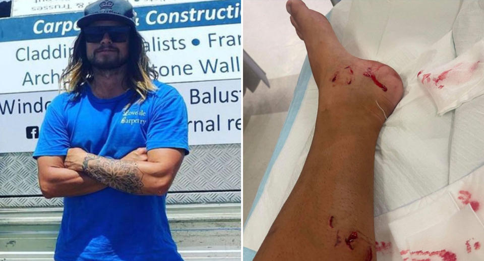 Pictured is Tim McAndrew, the tradie attacked by a shark on Tuesday and on the right, a picture of his leg, where the shark bit him