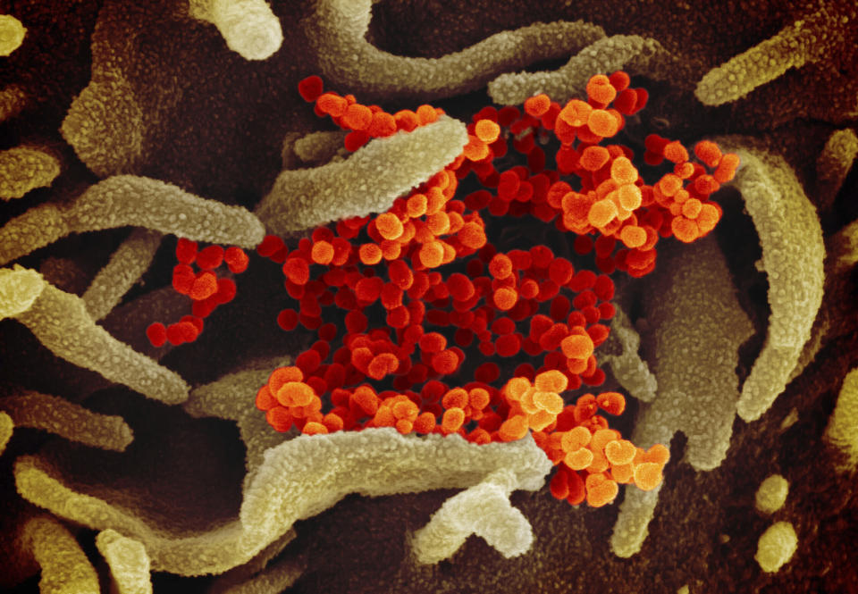 FILE - This file image provided by The National Institute of Allergy and Infectious Diseases (NIAID) shows SARS-CoV-2 (orange) the virus that causes COVID-19—isolated from a patient in the U.S., emerging from the surface of cells (green) cultured in the lab. A new type of coronavirus test offers a cheaper, quicker way to screen for infections, moving the U.S. toward the kind of mass screening that experts say is essential to returning millions of Americans to school and work. But the first so-called antigen test _ announced Saturday, may 9, 2020 by the Food and Drug Administration _ is not quite the kind sought by top government health officials. It is less accurate than the current gold standard for testing and can only be run on specialized equipment. (NIAID-RML via AP)