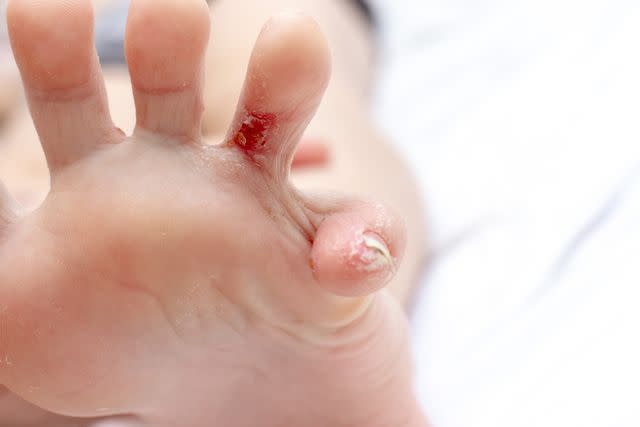 <p>Iuliia Mikhalitskaia / Getty Images </p> Dyshydrotic eczema on foot