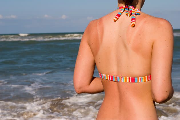 These tans lines aren't necessarily the best accessory for that strappy wedding guest dress. (Photo: Joel Carillet via Getty Images)