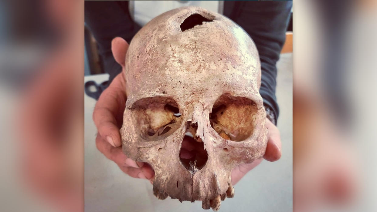  A skull dated to the Bronze Age with a hole in its cranium from trepanation. 