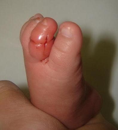 A person's hand holding a child's foot with a minor injury on the toe