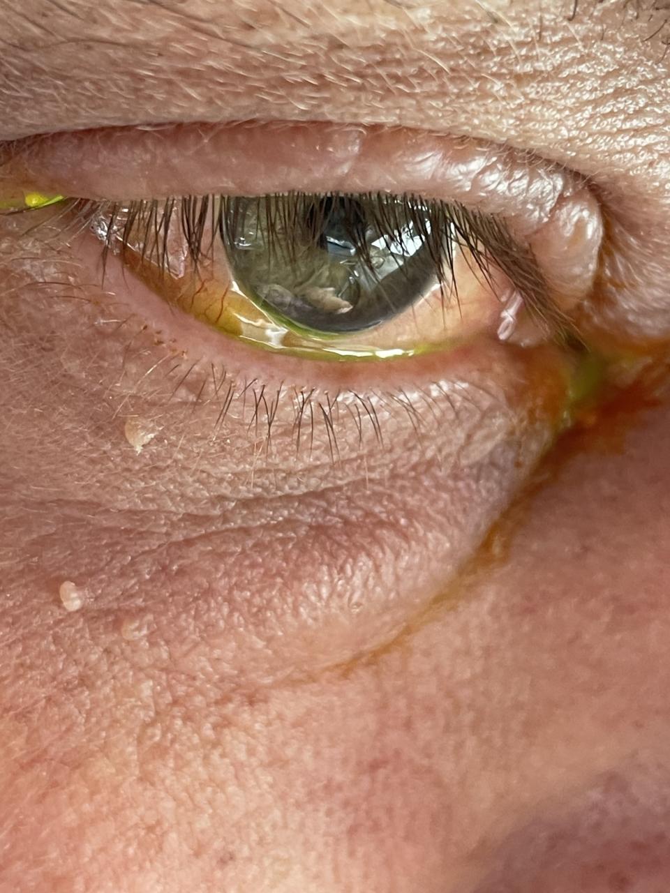 Stuart Vesty's 'Terminator' eye after he was bitten on the eyelid by a false widow spider. (Kennedy)