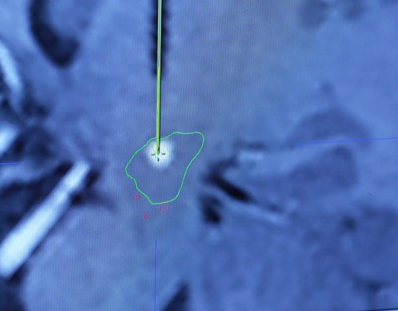 Using real-time MRI allows neurosurgeons at The Ohio State University Wexner Medical Center to precisely deliver a genetic therapeutic (white circle) directly to the precise site of the brain to help patients with a rare genetic disorder called AADC deficiency. Photo courtesy of The Ohio State University Wexner Medical Center