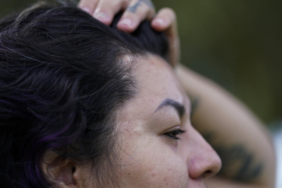 Vanessa Martinez shows her scars on Monday, March 20, 2023, in Chandler, Ariz. Doctors had to remove a third of her skull after Martinez was shot in the head by her ex-boyfriend in September 2021. She was denied victim compensation due to unpaid court fines. (AP Photo/Ashley Landis)