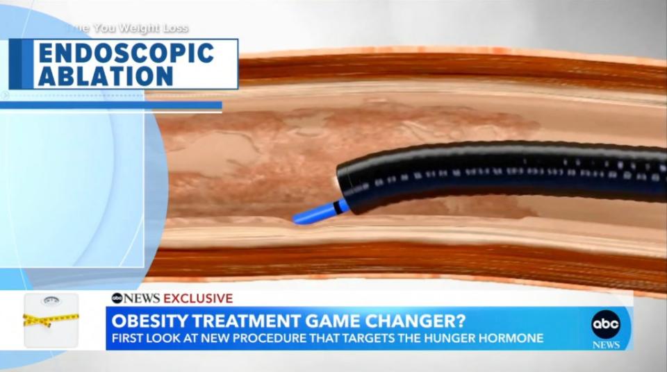 The procedure is minimally invasive but still has some risks. ABC News
