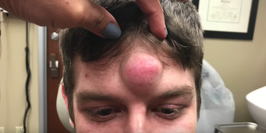 håndjern Logisk Blot Watch Dr. Pimple Popper Pop a HUGE 6-Year-Old “Unicorn Cyst” in the Middle  of a Man's Forehead