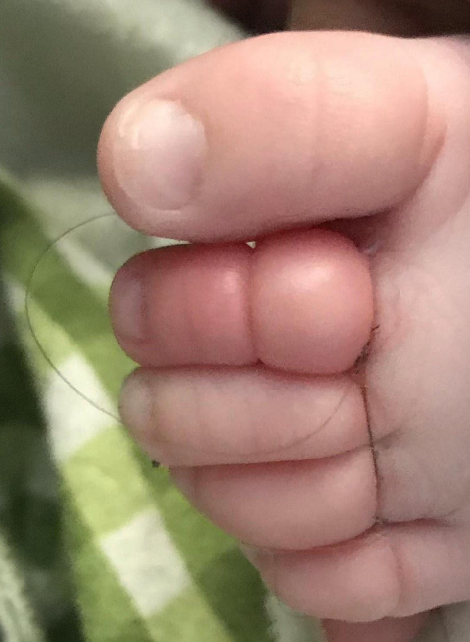 Baby Ezra’s badly swollen toe after a strand of hair cut off circulation. Source: Kennedy News and Media