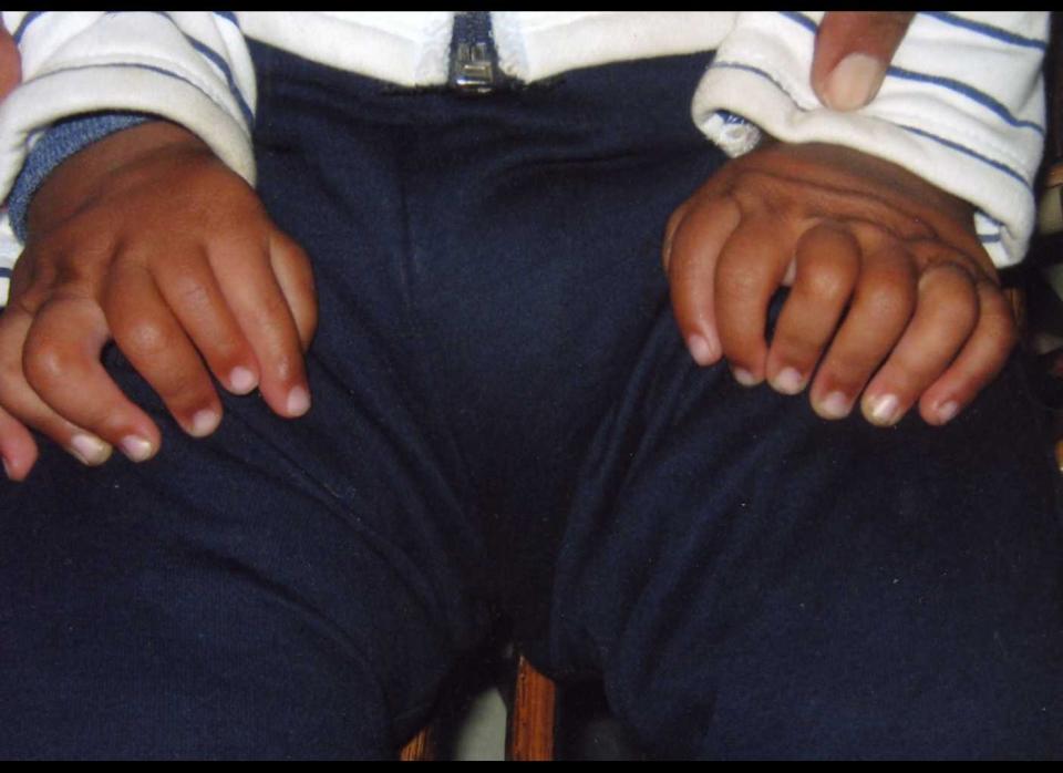 Akshat Saxena had 34 fingers and toes at birth in India in 2010. That set a Guinness World Record for most digits, although doctors later amputated many of them in 2011. 