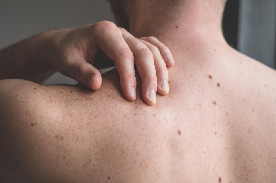 Close up detail of the bare skin on a man back with scattered moles and freckles. (Getty Images)