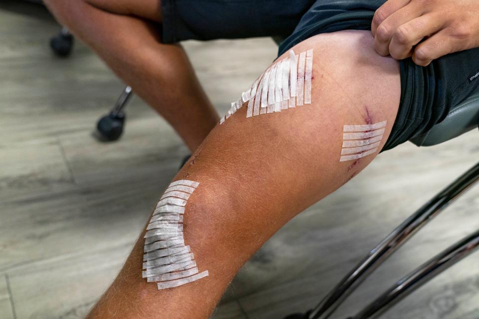 Marlin Wakeman, of Stuart, was bitten by Carribean reef sharks after he slipped and fell into the water in the Bahamas. Media gathered press at St. Mary's Medical Center to hear his story on May 9, 2024 in West Palm Beach, Florida.
