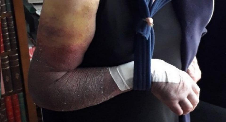 The elderly woman was left with her entire right arm covered in one giant bruise and a bad break (MET POLICE)