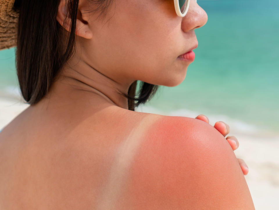 Sunburned skin on shoulder of a woman because of not using cream with sunscreen protection. Red skin sun burn after Sunbathing at the beach. Summer and holiday concept