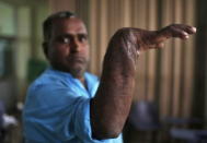 Visheshwar, a worker, displays his re-attached right hand, after an interview with Reuters in Gurgaon, January 5, 2016. REUTERS/Adnan Abidi/Files