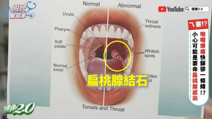 扁桃腺結石會出現喉嚨痛的症狀。（圖／翻攝自健康2.0 YouTube）