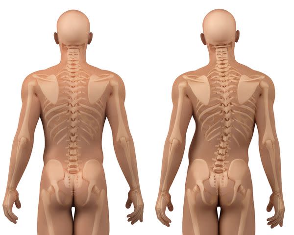 <p>SCIEPRO/Science Photo Library / Getty Images</p> Depictions of a skeleton with a straight spine and a spine with dextroscoliosis.
