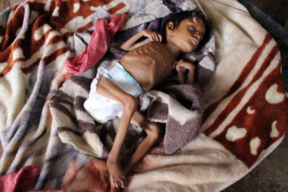 Salwa Ibrahim, a five-year-old girl suffering from acute malnutrition and weighing 3kg, sleeps on a bed inside an improvised house in Yemen’s northern Hajjah province (Getty)