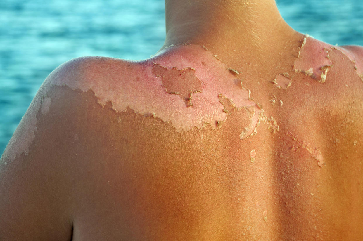 To a certain extent sun damage can be reversed [Photo: Getty]