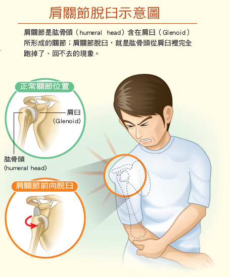 肩關節是肱骨頭（上圖左）含在肩臼（上圖右）所形成的關節；肩關節脫臼，就是肱骨頭從肩臼裡完全跑掉了、回不去的現象。上圖是正常關節位置，下圖是肩關節前向脫臼。