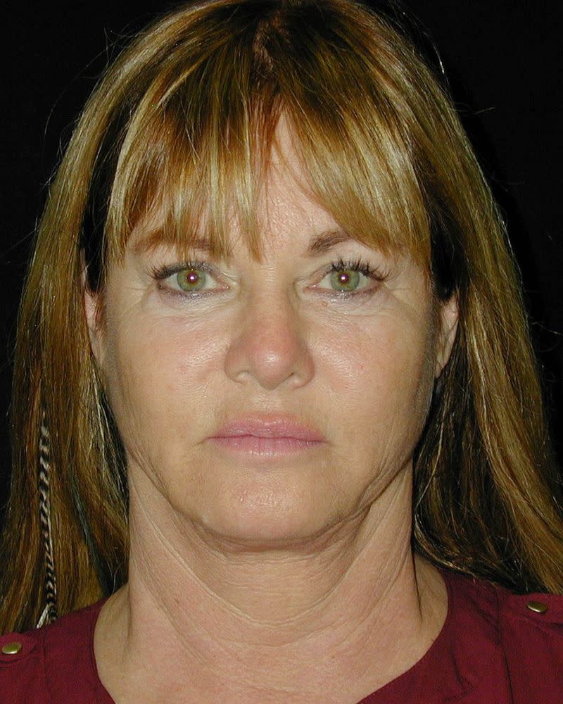 Jeana Keough before surgery