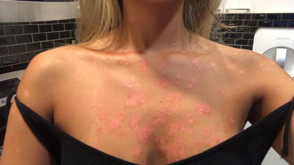 michelle lee tells women's health about her experience being diagnosed with plaque psoriasis