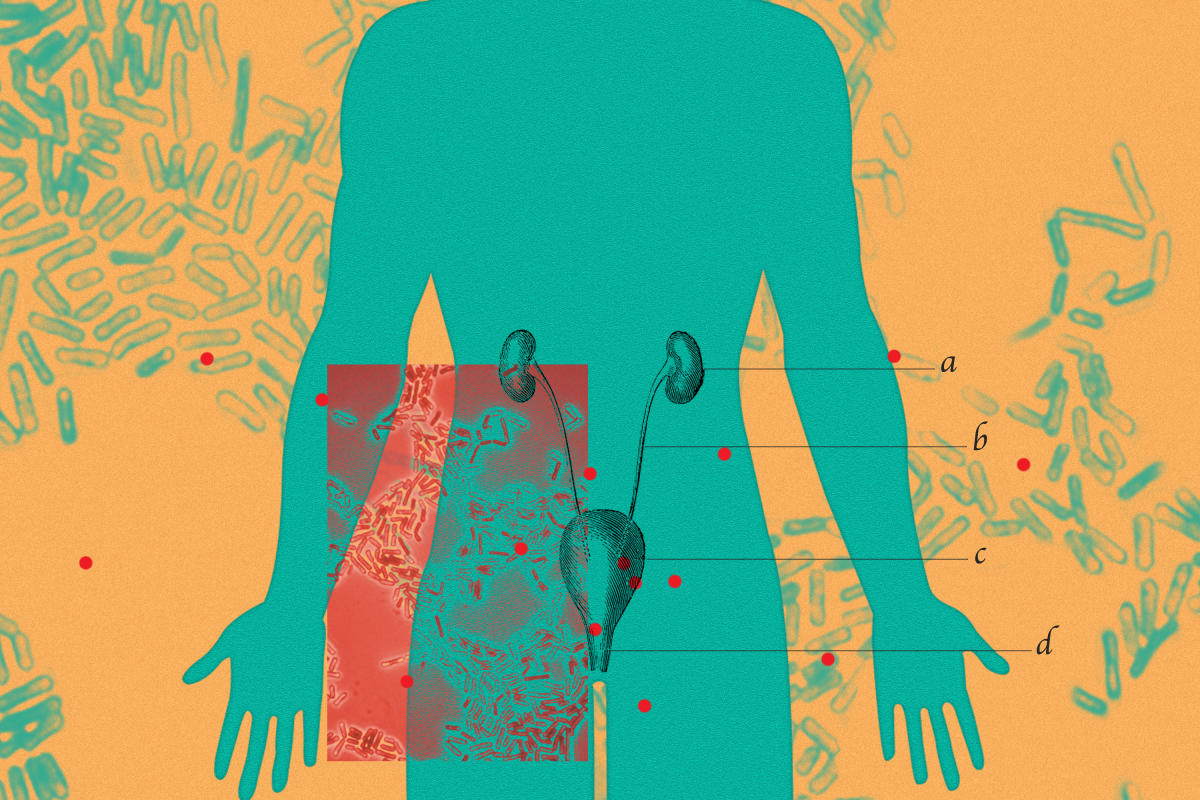 Understanding UTI's - Mount Sinai Medical Center