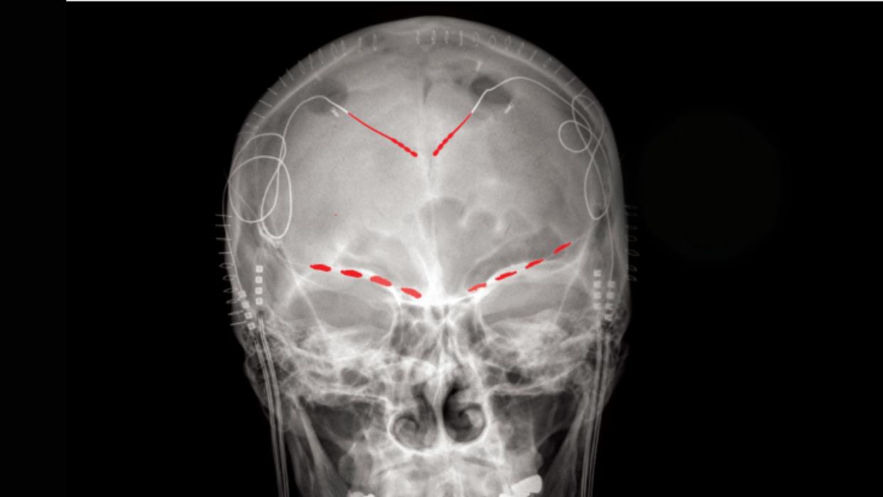  Frontal x-ray image of a human skull shows red lines where several electrodes have been implanted into the person's brain 