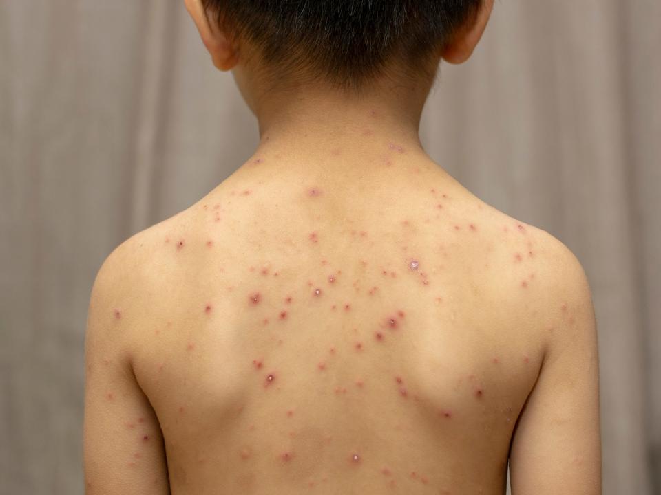 Chicken pox  - stock photo