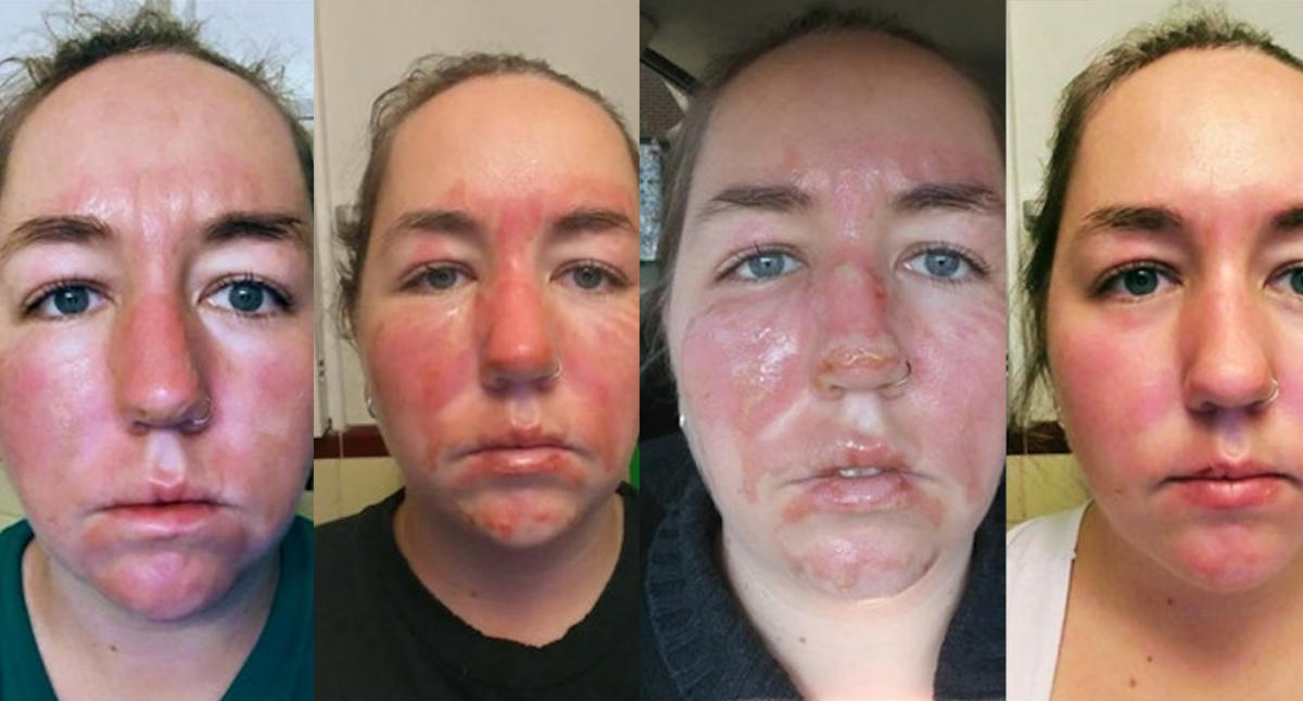 second degree burns on face healed