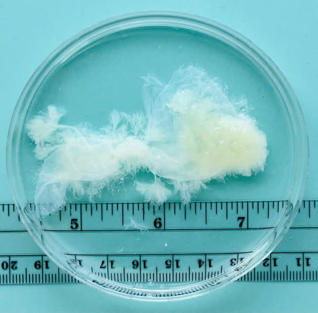 Tissue removed from the uterus at nine weeks of pregnancy. (Photo: Dr. Joan Fleischman, MD, MPA/MYA Network)