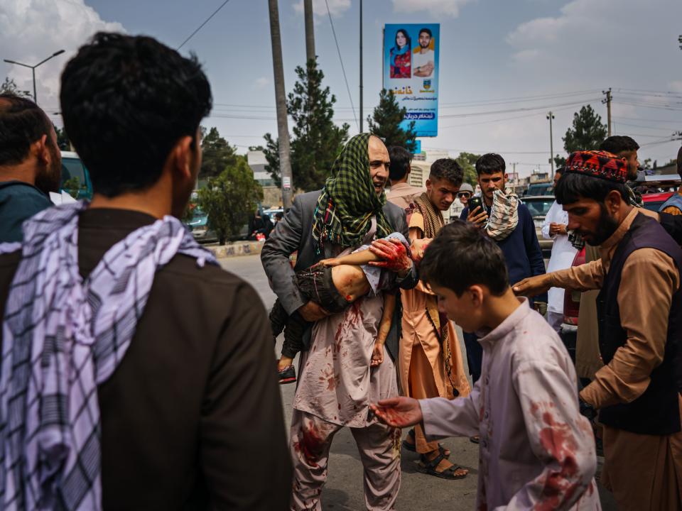 A wounded child in Kabul, Afghanistan