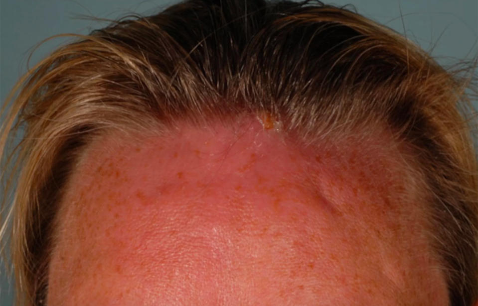 The lump can be seen at the 55-year-old’s hairline. Source: Credit: BMJ Case Reports 2019 via LiveScience