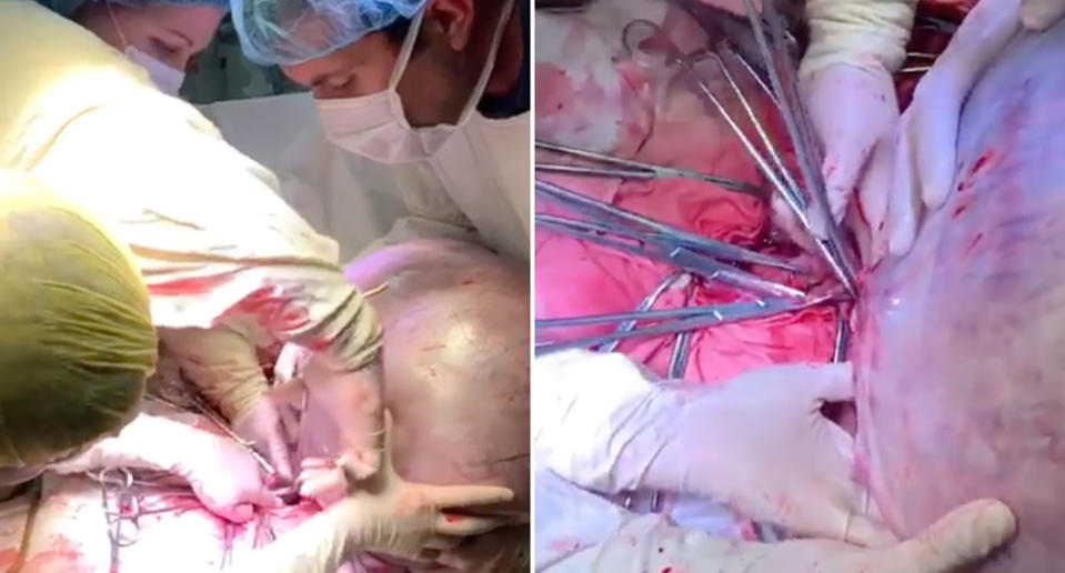 Doctors at a Moscow hospital work to remove a 25kg ovarian tumour from a woman's body. 