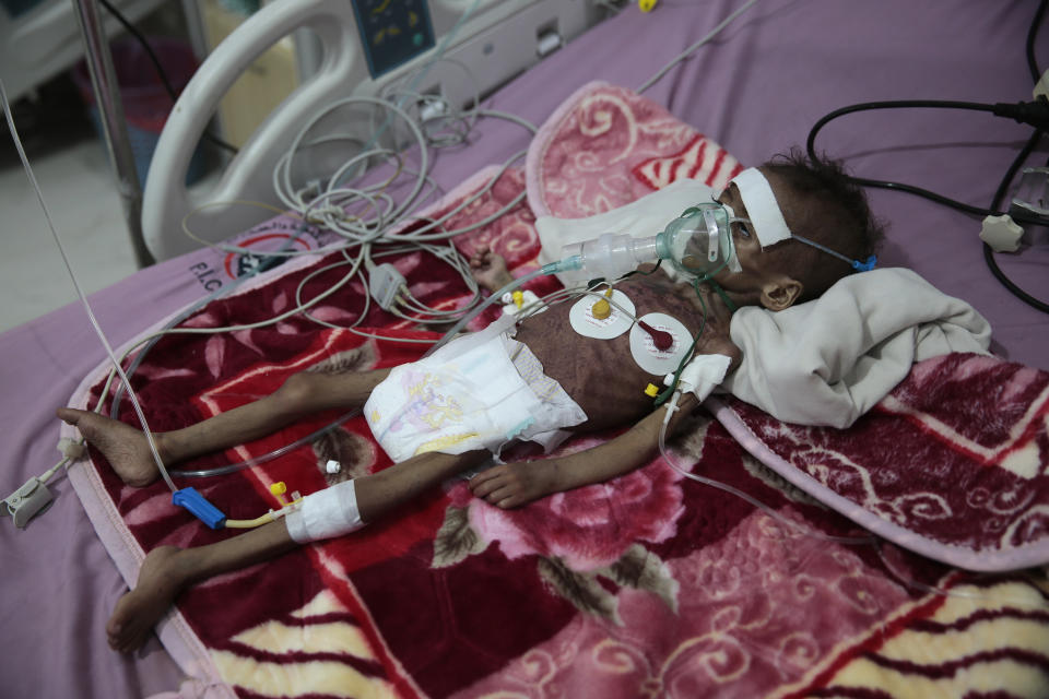 FILE - In this Nov. 3, 2020, file photo, malnourished girl, Rahmah Watheeq, receives treatment at a feeding center at Al-Sabeen hospital in Sanaa, Yemen. Countries like Lebanon, Syria, Iraq, Lebanon and Yemen are all teetering on the brink of humanitarian catastrophe with an economic implosion that threatens to throw the region into even deeper turmoil. (AP Photo/Hani Mohammed, File)