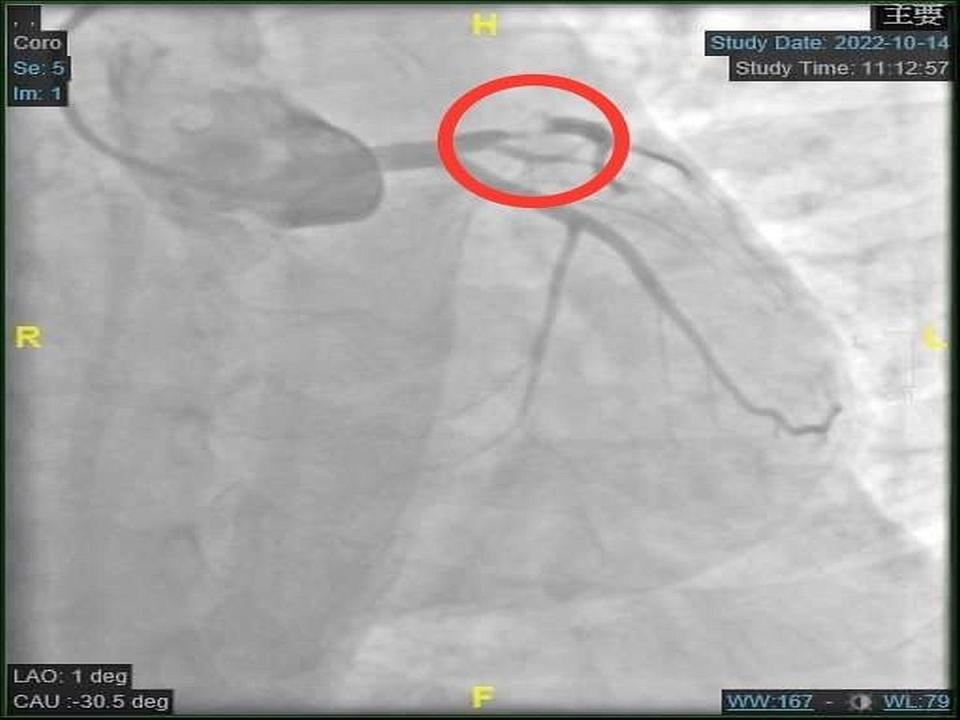 新一代的血管內影像，可以讓探頭到冠狀動脈內看清楚血管的管徑以及長度。（圖：大里仁愛醫院提供）