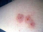 <p><strong>What they look like:</strong> If you’ve got two tiny puncture marks on your skin (or <a href="https://www.prevention.com/health/g29022991/common-house-spiders/" rel="nofollow noopener" target="_blank" data-ylk="slk:see a spider;elm:context_link;itc:0;sec:content-canvas" class="link ">see a spider</a> crawling away), you are probably dealing with a <a href="https://www.prevention.com/health/a29109758/spider-bite-pictures-symptoms/" rel="nofollow noopener" target="_blank" data-ylk="slk:spider bite;elm:context_link;itc:0;sec:content-canvas" class="link ">spider bite</a>. Redness and swelling at the site of the bite are also common. Thankfully, most spiders bite only when provoked.</p><p><strong>Symptoms to note:</strong> Innocuous spider bites often cause mild pain (like a bee sting) and even itching. But watch out for <a href="https://www.prevention.com/health/a28815671/susie-torres-brown-recluse-spider-in-ear/" rel="nofollow noopener" target="_blank" data-ylk="slk:brown recluses;elm:context_link;itc:0;sec:content-canvas" class="link ">brown recluses</a> and black widows: The former can cause necrotic lesions, while the latter can bring on muscle spasms, tremors, and nausea. Seek medical help if you suspect a bite from either of these spiders.</p><p><strong>RELATED: <a href="https://www.prevention.com/health/a29210527/how-to-treat-a-spider-bite/" rel="nofollow noopener" target="_blank" data-ylk="slk:How to Treat a Spider Bite;elm:context_link;itc:0;sec:content-canvas" class="link ">How to Treat a Spider Bite</a></strong></p>