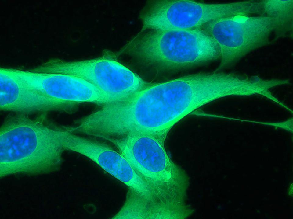 melanoma cancer cells