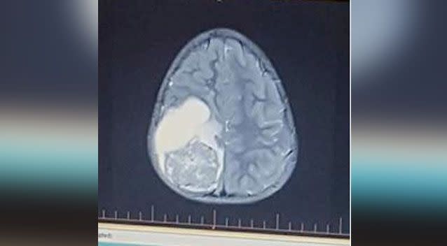 An MRI revealed the tumour on the right side of her brain. Photo: Give A Little