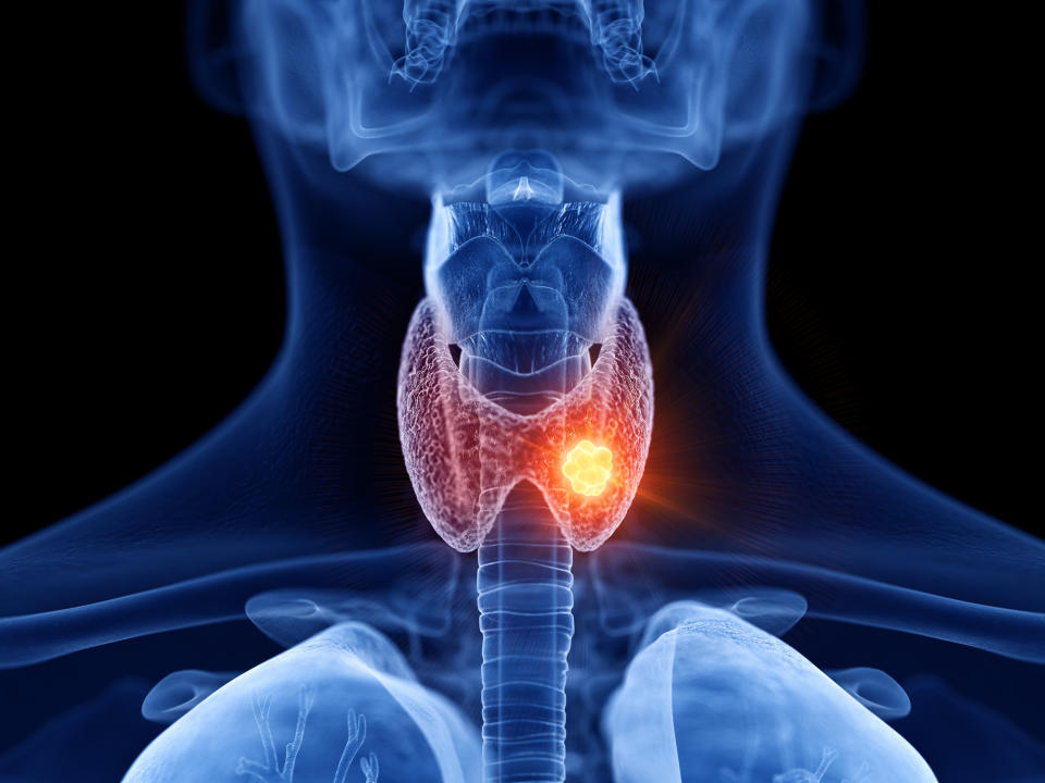 A scan of the thyroid